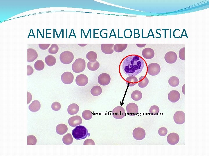ANEMIA MEGALOBLASTICA Neutrófilos hipersegmentado ANEMIA MEGALOBLASTICA Neutrófilos hipersegmentado