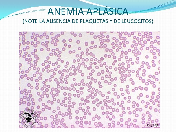 ANEMIA APLÁSICA (NOTE LA AUSENCIA DE PLAQUETAS Y DE LEUCOCITOS) ANEMIA APLÁSICA (NOTE LA AUSENCIA DE PLAQUETAS Y DE LEUCOCITOS)