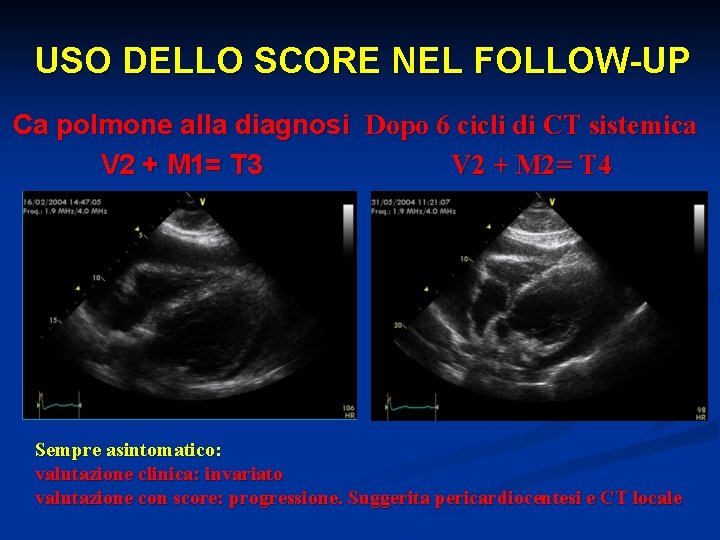 USO DELLO SCORE NEL FOLLOW-UP Ca polmone alla diagnosi Dopo 6 cicli di CT