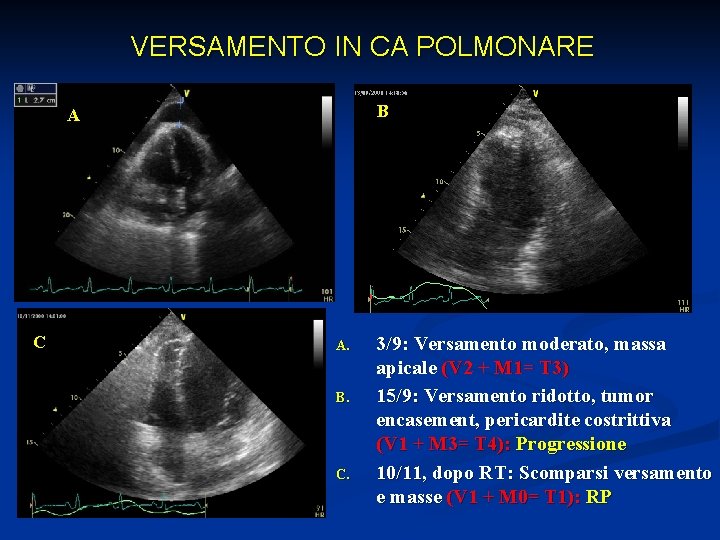 VERSAMENTO IN CA POLMONARE B A C A. B. C. 3/9: Versamento moderato, massa