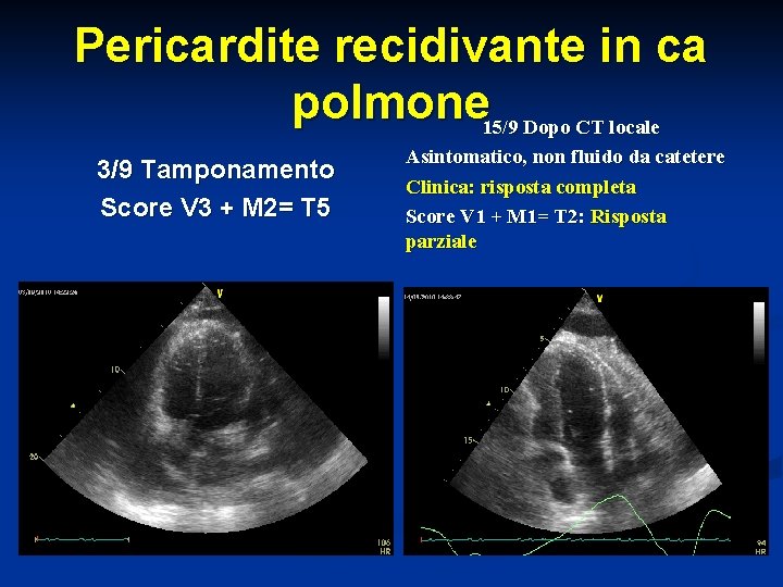 Pericardite recidivante in ca polmone 15/9 Dopo CT locale 3/9 Tamponamento Score V 3