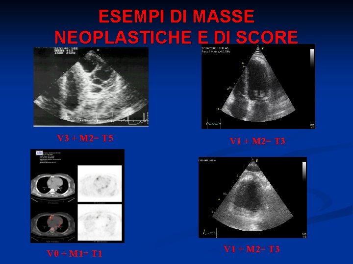 ESEMPI DI MASSE NEOPLASTICHE E DI SCORE V 3 + M 2= T 5