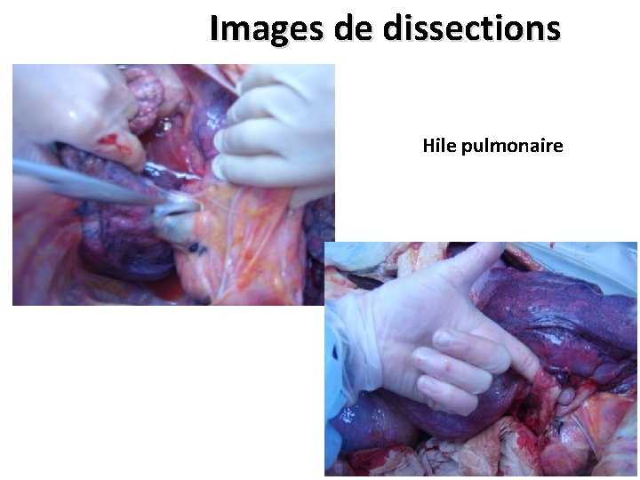 Images de dissections Hile pulmonaire 