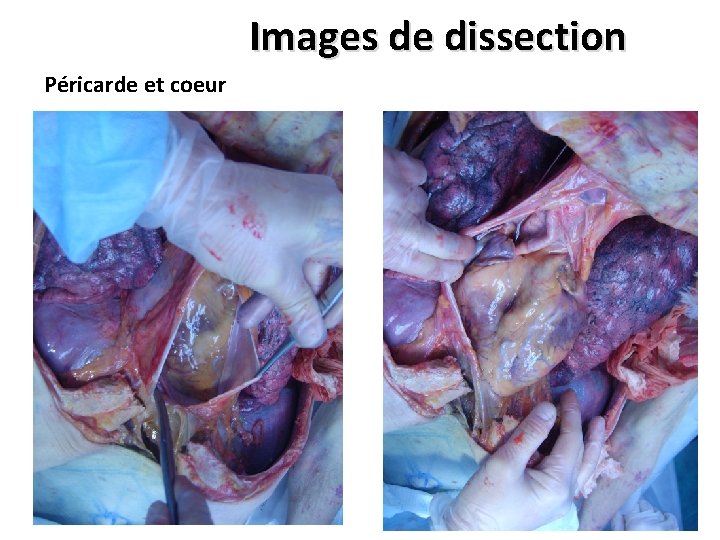 Images de dissection Péricarde et coeur Images de dissection Péricarde et coeur