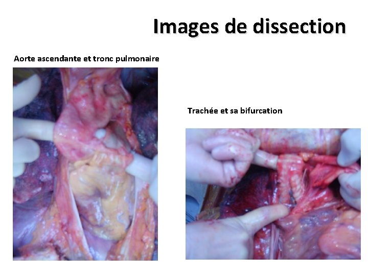 Images de dissection Aorte ascendante et tronc pulmonaire Trachée et sa bifurcation 