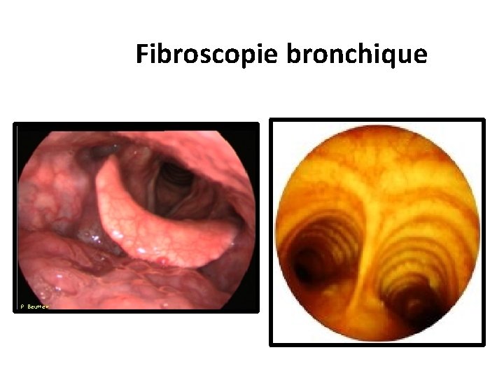 Fibroscopie bronchique 