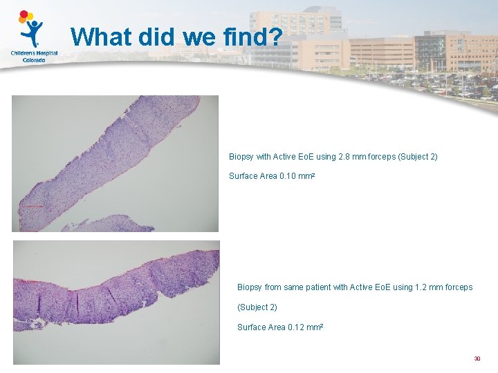 What did we find? Biopsy with Active Eo. E using 2. 8 mm forceps