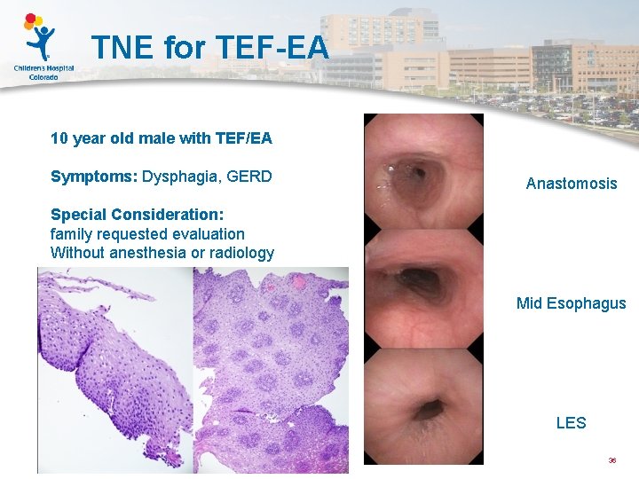 TNE for TEF-EA 10 year old male with TEF/EA Symptoms: Dysphagia, GERD Anastomosis Special