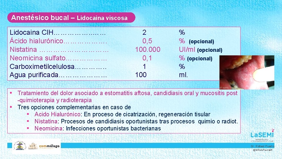 Anestésico bucal – Lidocaina viscosa Lidocaina Cl. H……………. . …… 2 Ácido hialurónico………………. 0,