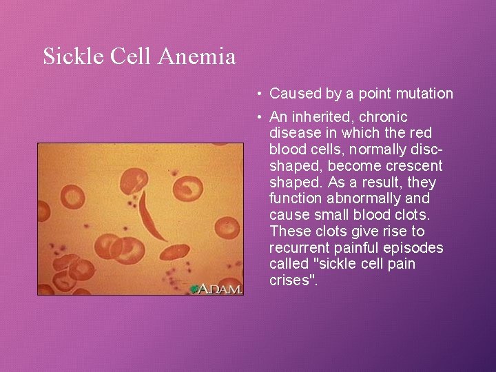 Sickle Cell Anemia • Caused by a point mutation • An inherited, chronic disease