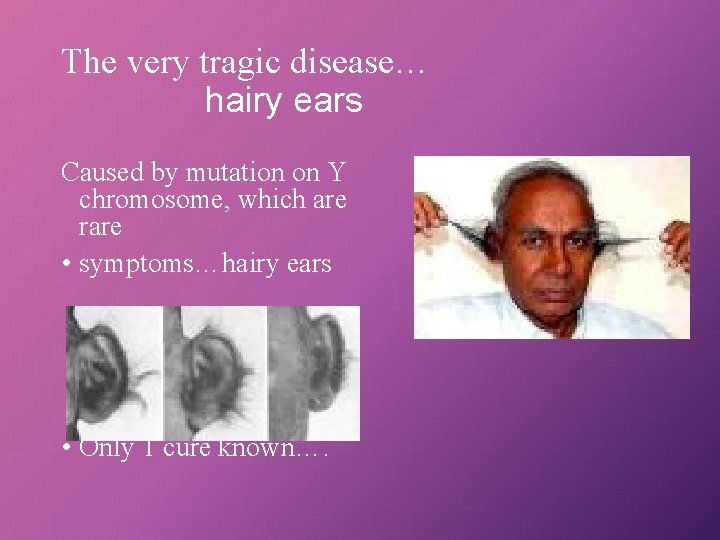The very tragic disease… hairy ears Caused by mutation on Y chromosome, which are