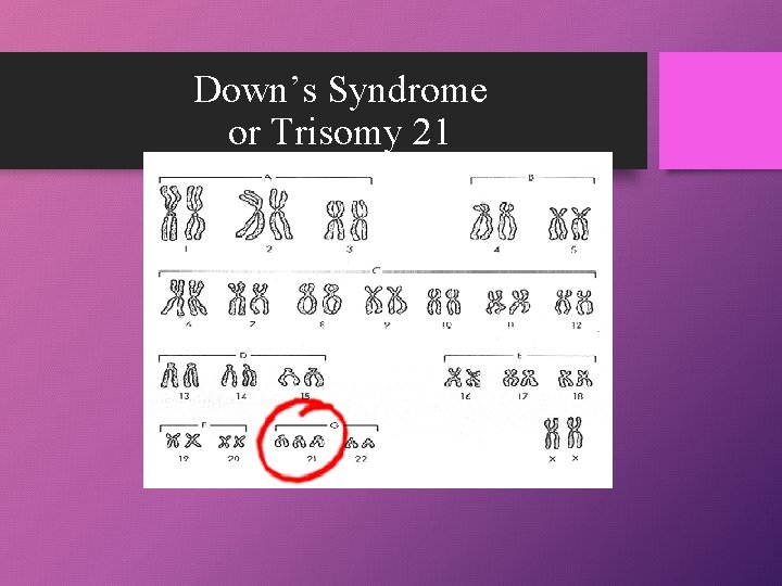 Down’s Syndrome or Trisomy 21 