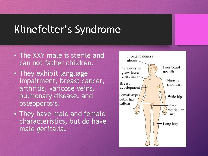 Klinefelter’s Syndrome • The XXY male is sterile and can not father children. •