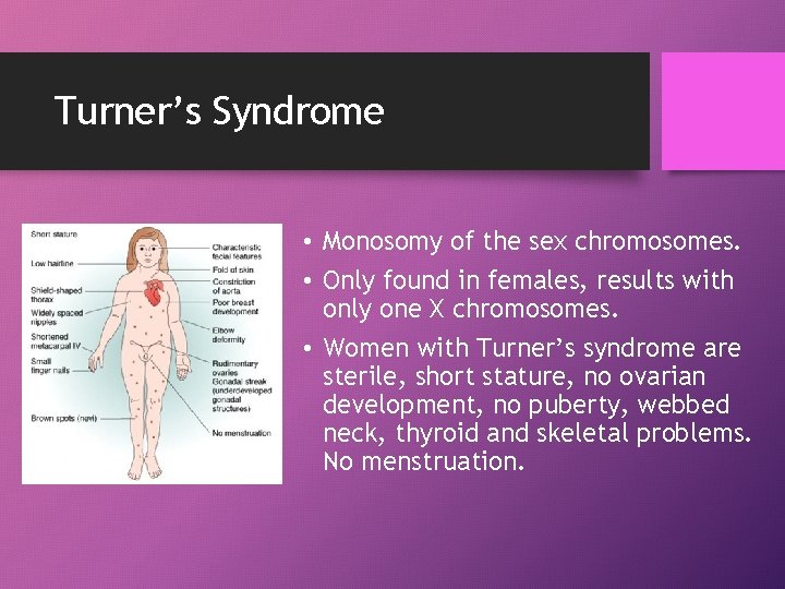 Turner’s Syndrome • Monosomy of the sex chromosomes. • Only found in females, results