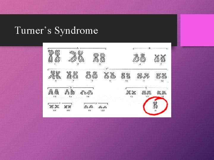 Turner’s Syndrome 