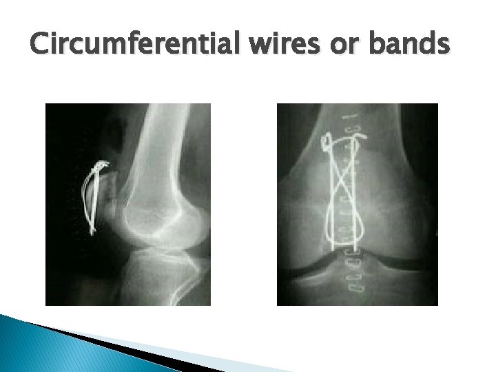 Circumferential wires or bands 