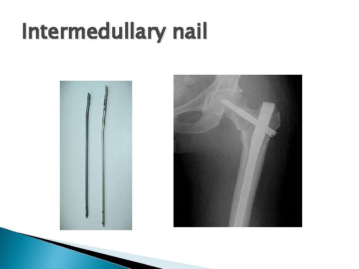 Intermedullary nail 
