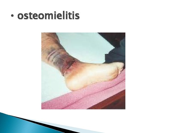  • osteomielitis 