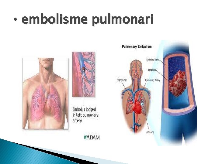  • embolisme pulmonari 