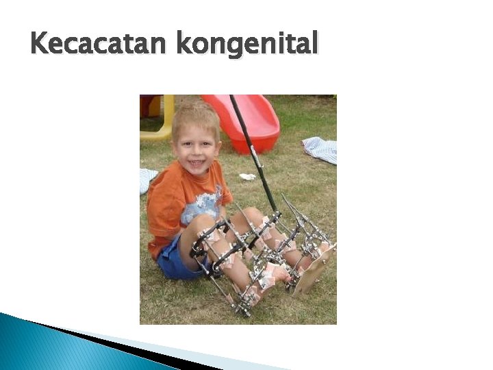 Kecacatan kongenital 