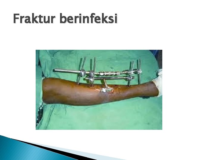 Fraktur berinfeksi 