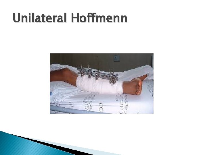 Unilateral Hoffmenn 