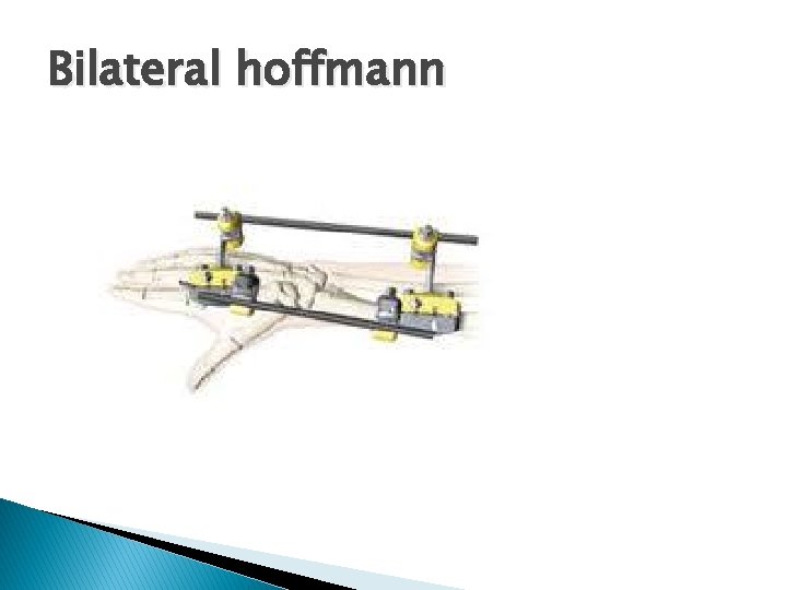 Bilateral hoffmann 