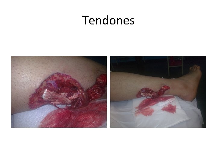 Tendones 