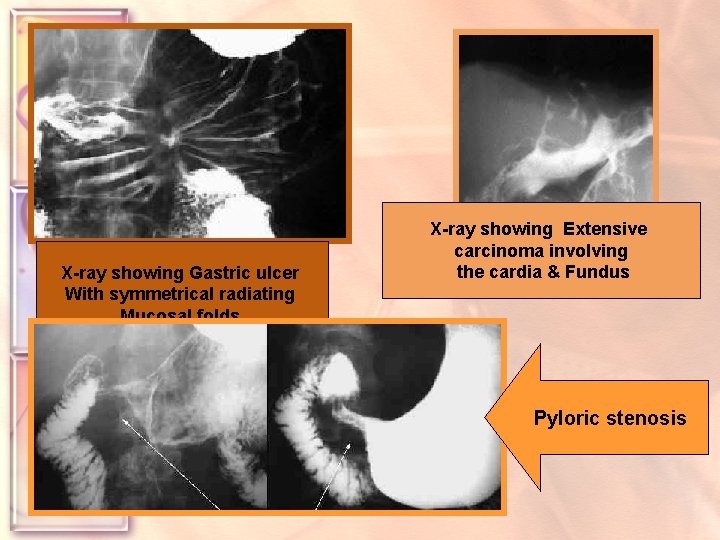 X-ray showing Gastric ulcer With symmetrical radiating Mucosal folds. By histology, no evidence of