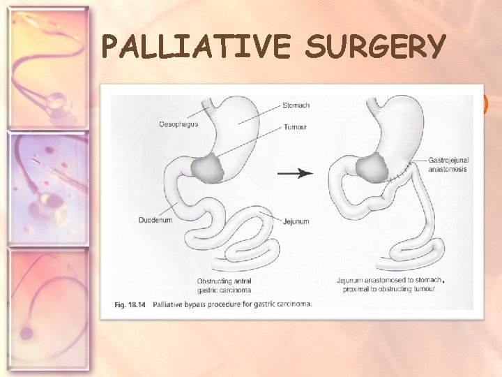 PALLIATIVE SURGERY • For pts with advanced (inoperable) disease & suffering significant symptoms e.