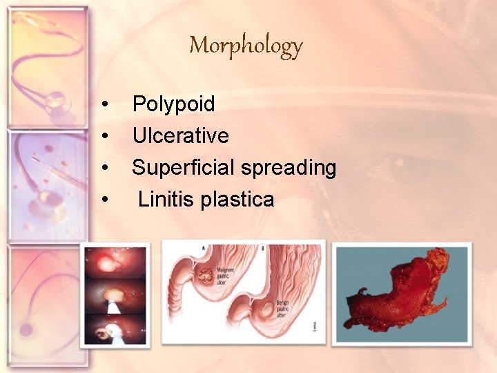 Morphology • • Polypoid Ulcerative Superficial spreading Linitis plastica 