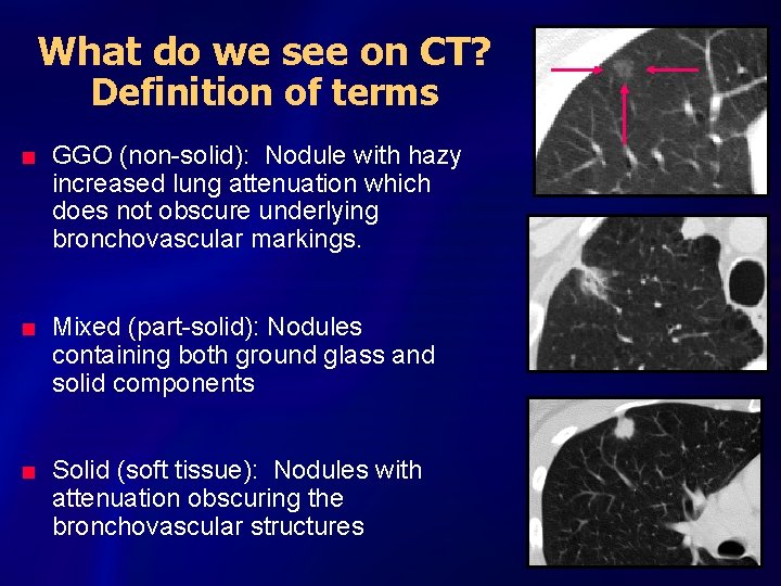 What do we see on CT? Definition of terms n n n GGO (non-solid):