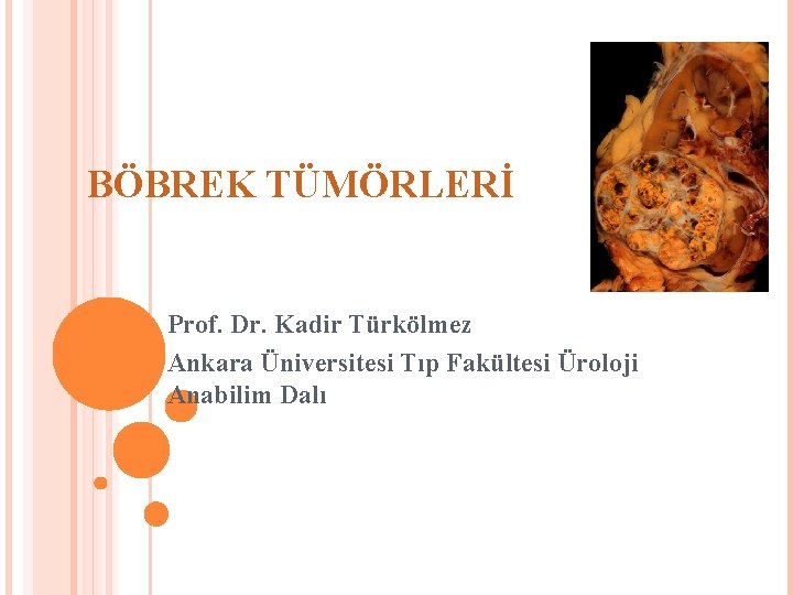 BÖBREK TÜMÖRLERİ Prof. Dr. Kadir Türkölmez Ankara Üniversitesi Tıp Fakültesi Üroloji Anabilim Dalı 