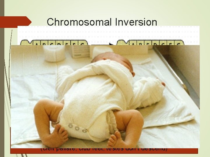 Chromosomal Inversion a segment of genes flip end-to-end on the chromosome Causes: Four-Ring Syndrome