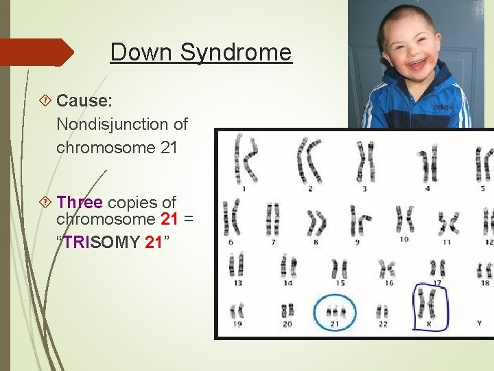 Down Syndrome Cause: Nondisjunction of chromosome 21 Three copies of chromosome 21 = “TRISOMY