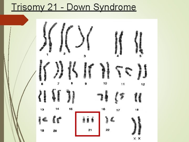 Trisomy 21 - Down Syndrome 