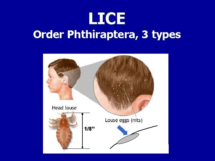 LICE Order Phthiraptera, 3 types 1/8” 