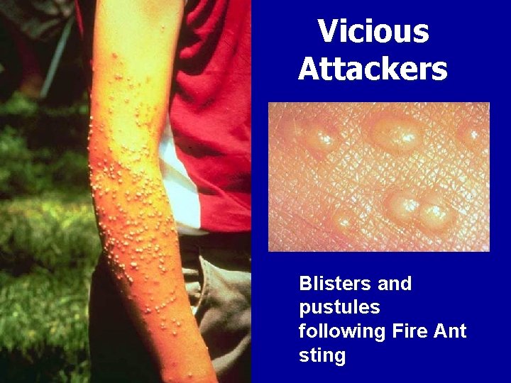 Vicious Attackers Blisters and pustules following Fire Ant sting 