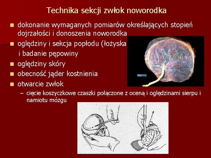 Technika sekcji zwłok noworodka dokonanie wymaganych pomiarów określających stopień dojrzałości i donoszenia noworodka n