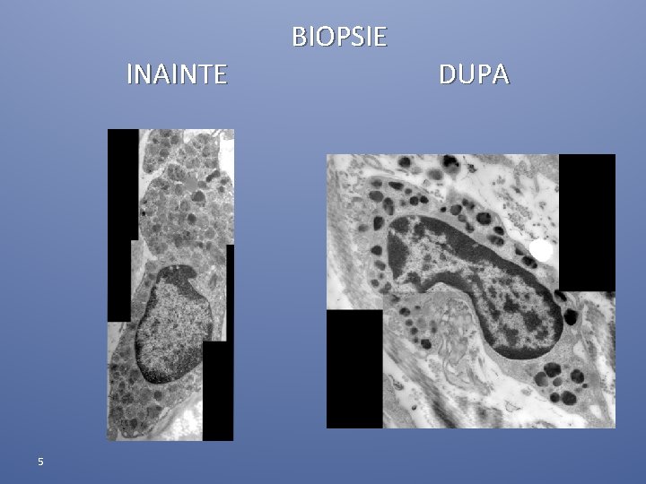 INAINTE 5 BIOPSIE DUPA INAINTE 5 BIOPSIE DUPA
