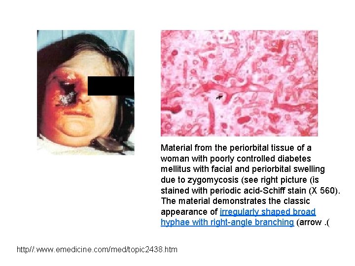 Material from the periorbital tissue of a woman with poorly controlled diabetes mellitus with