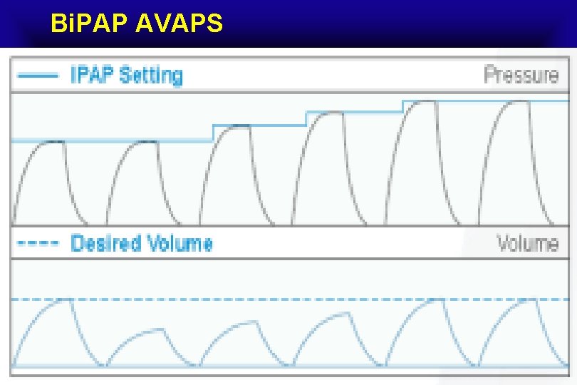 Bi Pap Avaps By Ahmad Younes Professor Of