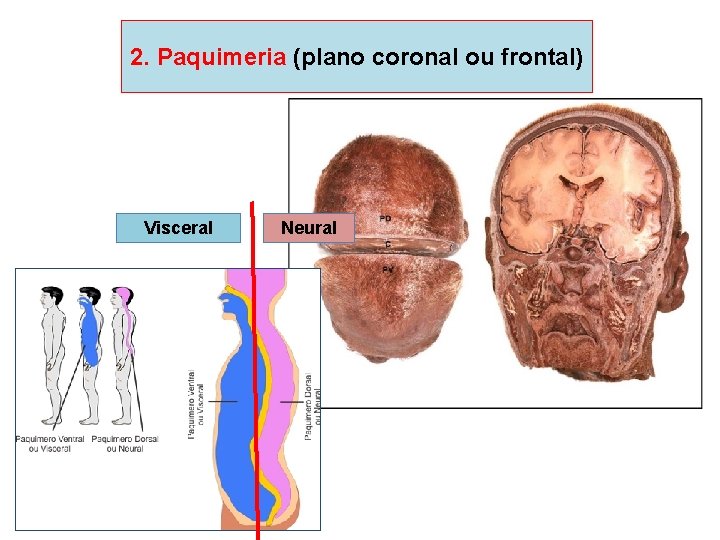2. Paquimeria (plano coronal ou frontal) Visceral Neural 