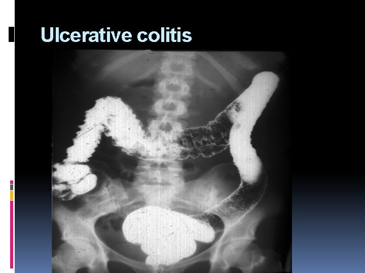 Ulcerative colitis 