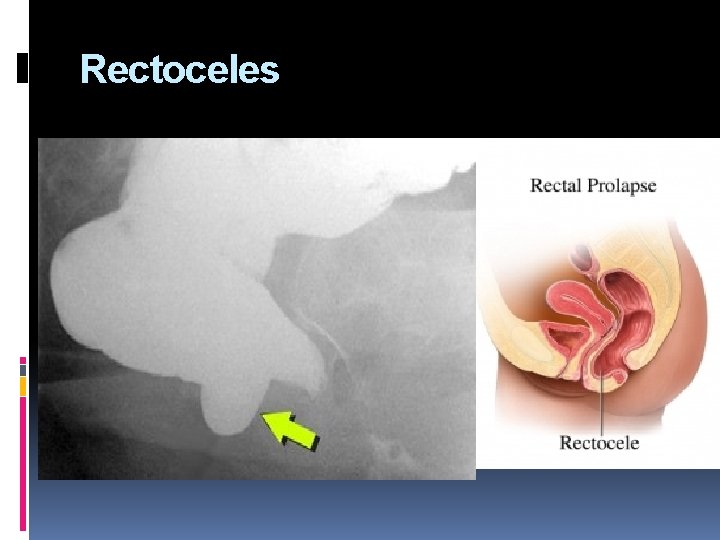 Rectoceles 