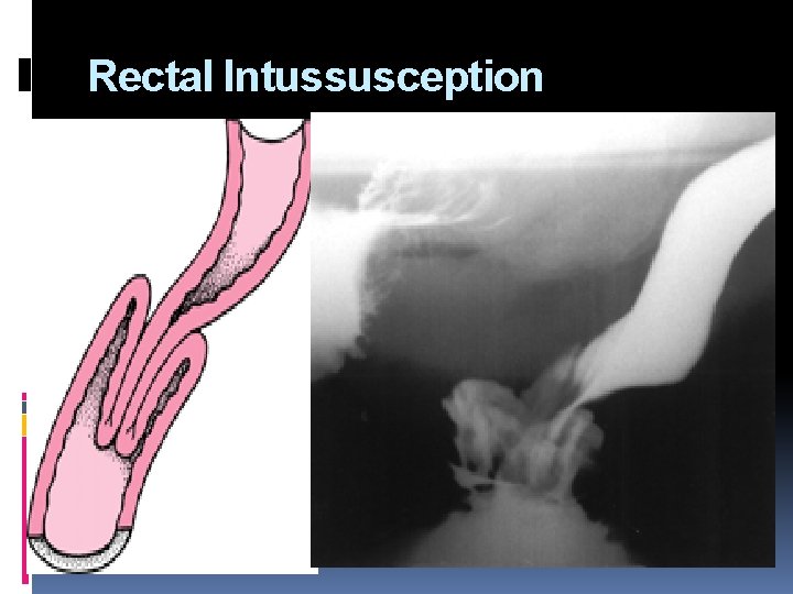 Rectal Intussusception 