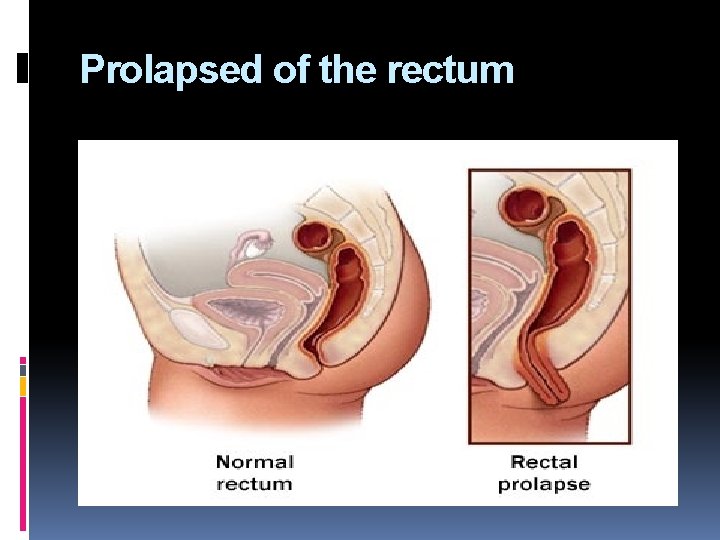 Prolapsed of the rectum 