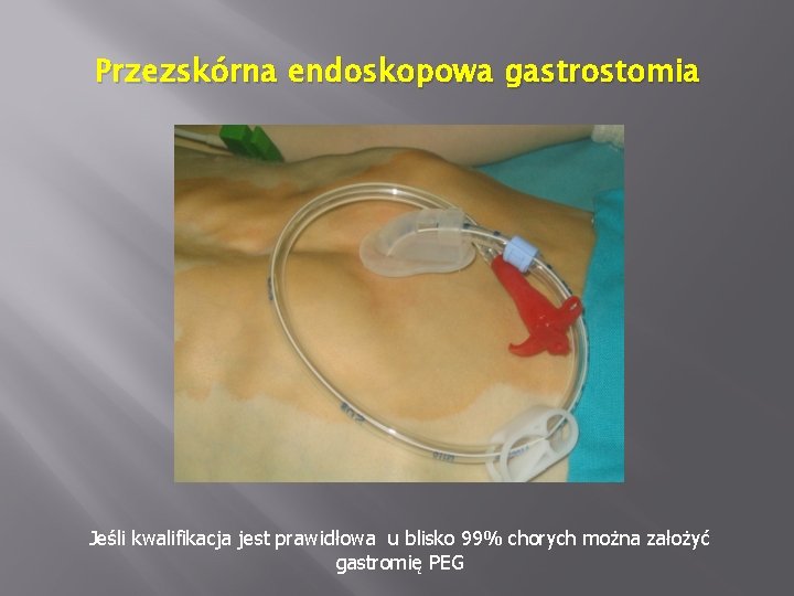 Przezskórna endoskopowa gastrostomia Jeśli kwalifikacja jest prawidłowa u blisko 99% chorych można założyć gastromię