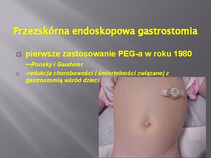 Przezskórna endoskopowa gastrostomia pierwsze zastosowanie PEG-a w roku 1980 --Ponsky i Gauderer -redukcja chorobowości
