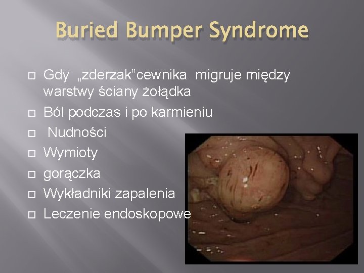 Buried Bumper Syndrome Gdy „zderzak”cewnika migruje między warstwy ściany żołądka Ból podczas i po